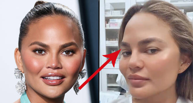 Chrissy Teigen claps back at criticism for having an eyebrow transplant.