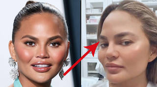 Chrissy Teigen claps back at criticism for having an eyebrow transplant.