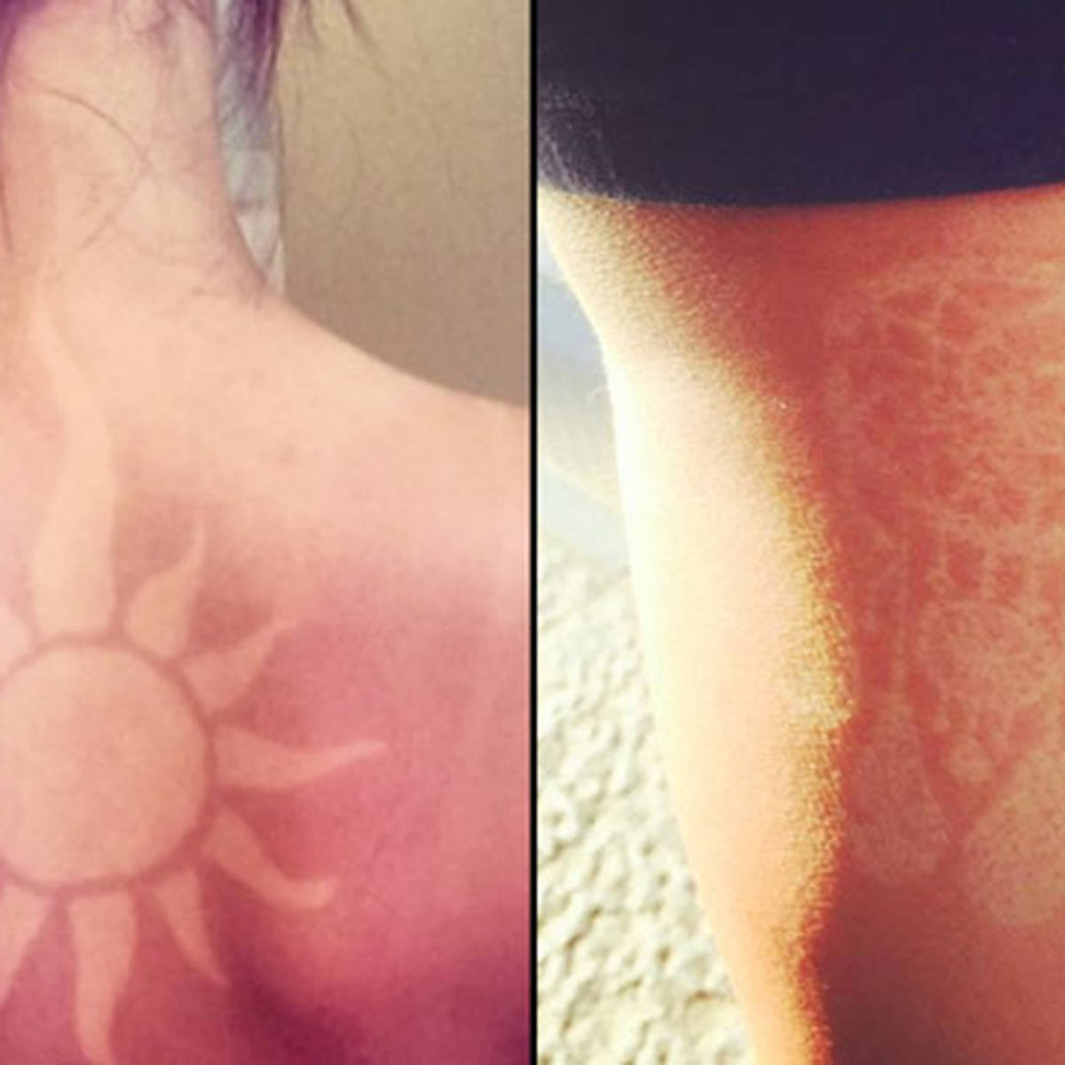 People are giving themselves sunburn tattoos and it's SO dangerous - PopBuzz