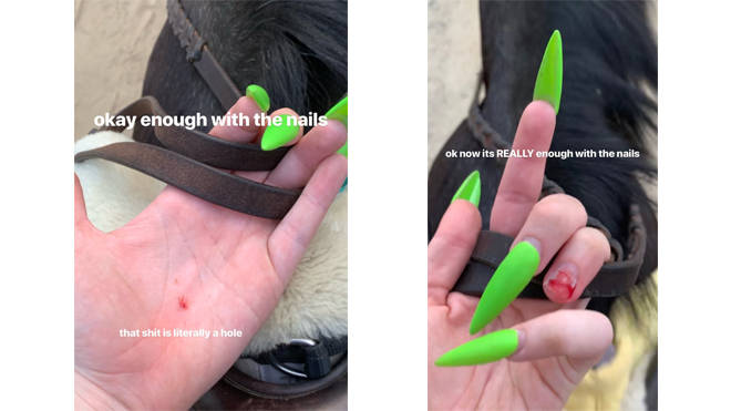 Billie Eilish shows how she ripped off her fingernail on Instagram